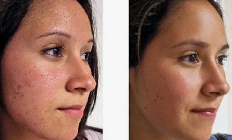 Before &After